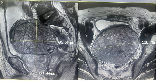 Bệnh viện Hữu Nghị cắt bỏ u tuyến tiền liệt 'khủng' 600 gram cho cụ ông 83 tuổi- Ảnh 2.