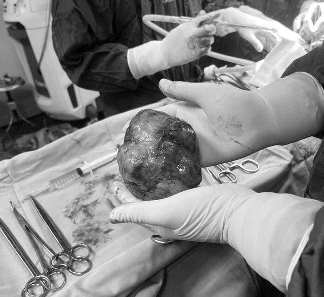 Bệnh viện Hữu Nghị cắt bỏ u tuyến tiền liệt 'khủng' 600 gram cho cụ ông 83 tuổi- Ảnh 3.