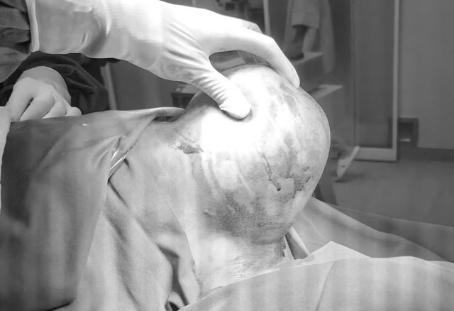 Khối u khổng lồ 1,5kg 