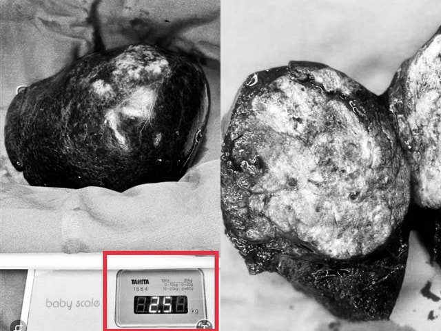 Cắt bỏ khối u gan khổng lồ 2,5 kg- Ảnh 2.