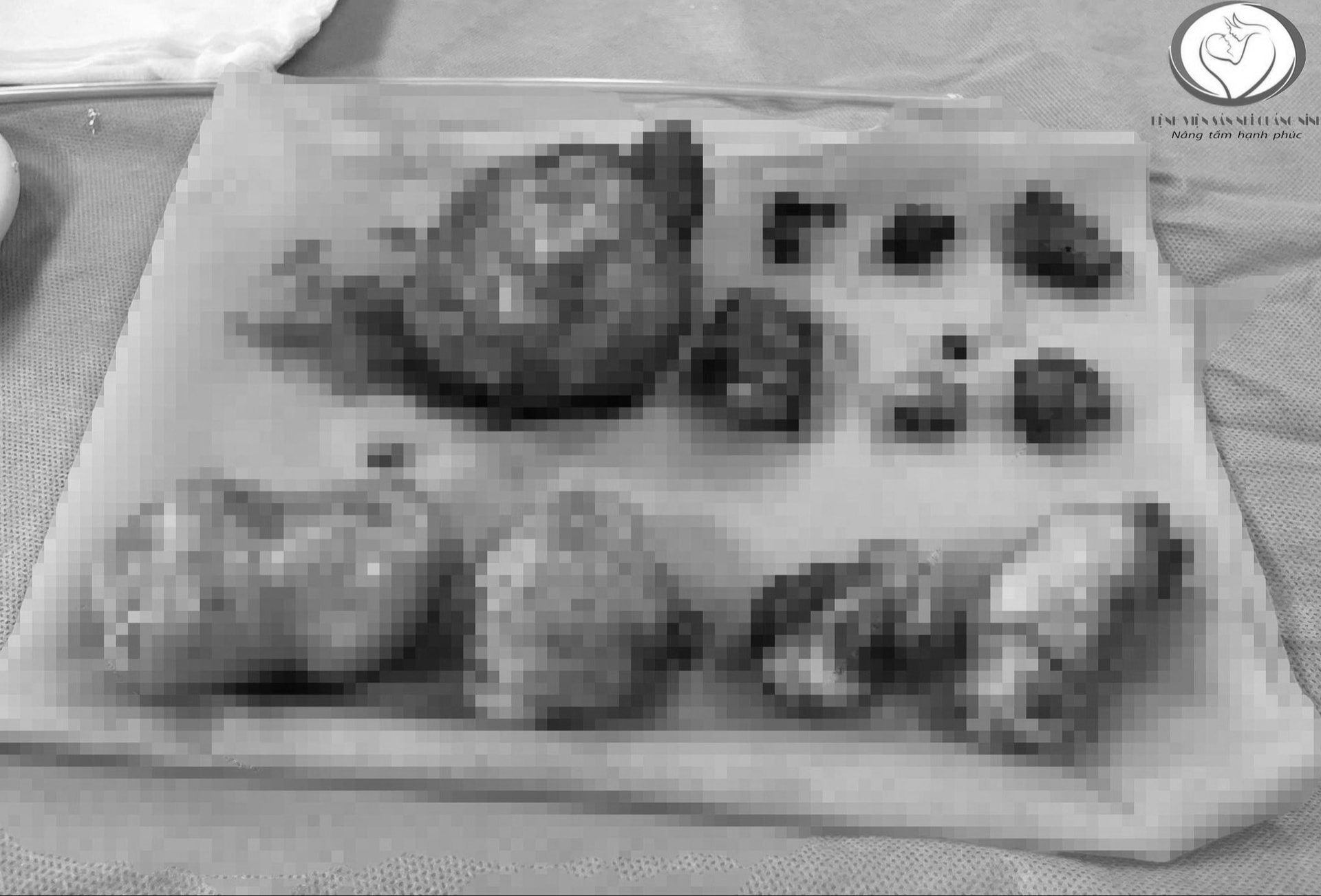 Một phụ nữ hiếm muộn mang trong mình 11 khối u xơ phát triển phức tạp- Ảnh 1.