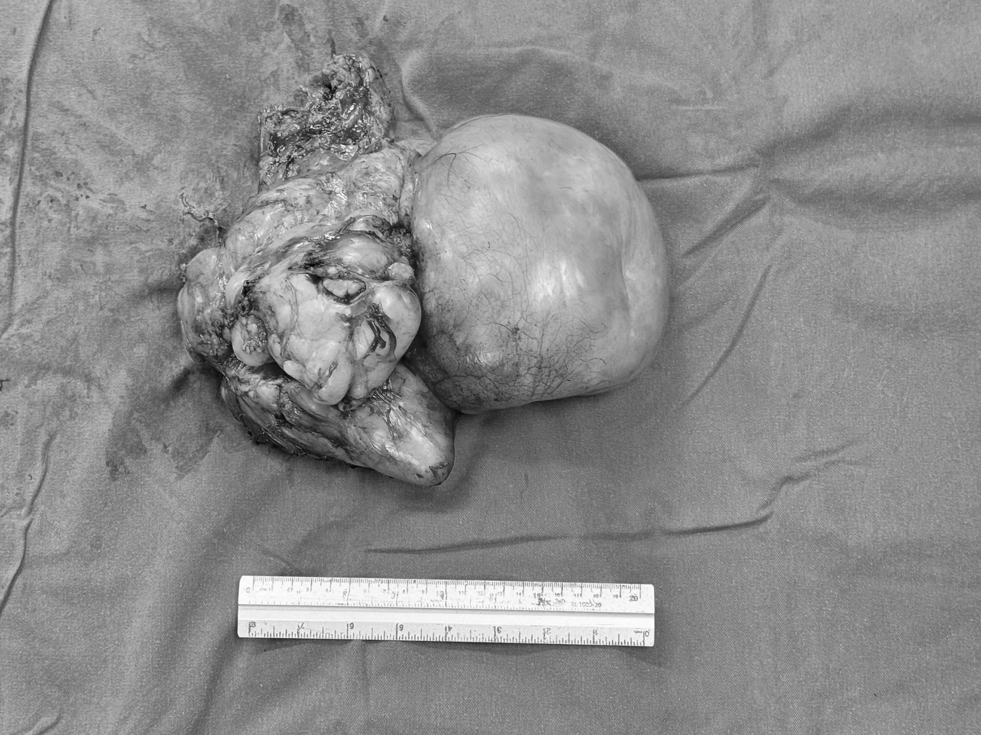 Bụng cụ bà to bất thường, căng tức, bác sĩ phẫu thuật lấy ra khối u ác tính gần 4kg- Ảnh 2.