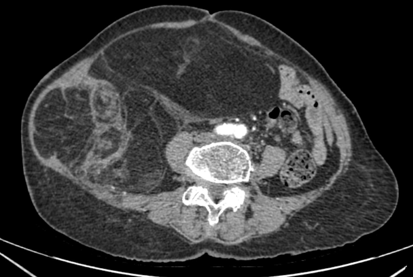 Bụng cụ bà to bất thường, căng tức, bác sĩ phẫu thuật lấy ra khối u ác tính gần 4kg- Ảnh 1.