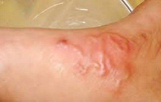 Nhiều trường hợp ở Khánh Hòa bị sán chó, người dân chủ động phòng bệnh- Ảnh 2.