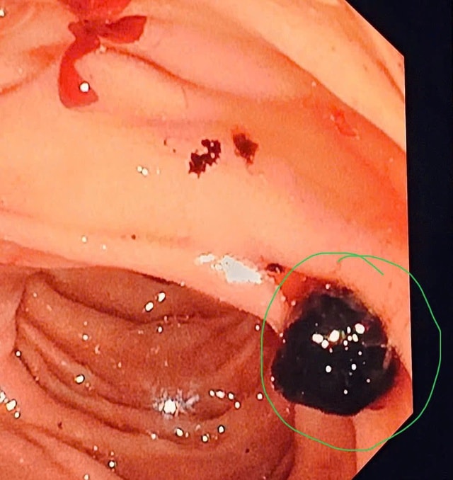 Bệnh viện Đa khoa tỉnh Thanh Hóa làm chủ kỹ thuật nội soi mật tụy ngược dòng can thiệp (ERCP)- Ảnh 1. Bệnh viện Đa khoa tỉnh Thanh Hóa làm chủ kỹ thuật nội soi mật tụy ngược dòng can thiệp (ERCP)- Ảnh 1.