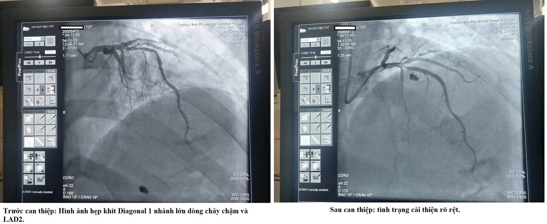 Hồi sinh sự sống cho cụ ông 70 tuổi bị nhồi máu cơ tim cấp trong đêm- Ảnh 1.