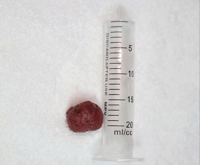 Cứu bé trai 13 tuổi bị lồng ruột nhờ loại bỏ polyp đại tràng lớn- Ảnh 3.