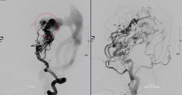 Cô bé 10 tuổi vượt qua 8 lần can thiệp mạch máu não, mơ ước khoác áo blouse trắng- Ảnh 1. Cô bé 10 tuổi vượt qua 8 lần can thiệp mạch máu não, mơ ước khoác áo blouse trắng- Ảnh 1.