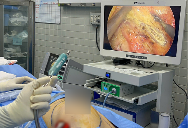 Ca phẫu thuật ít xâm lấn tái tạo vú đầu tiên ở người ghép thận tại Việt Nam- Ảnh 1.