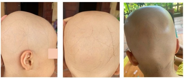 Bé gái 7 tuổi rụng hết tóc bất ngờ mọc kín đầu sau một năm- Ảnh 1.