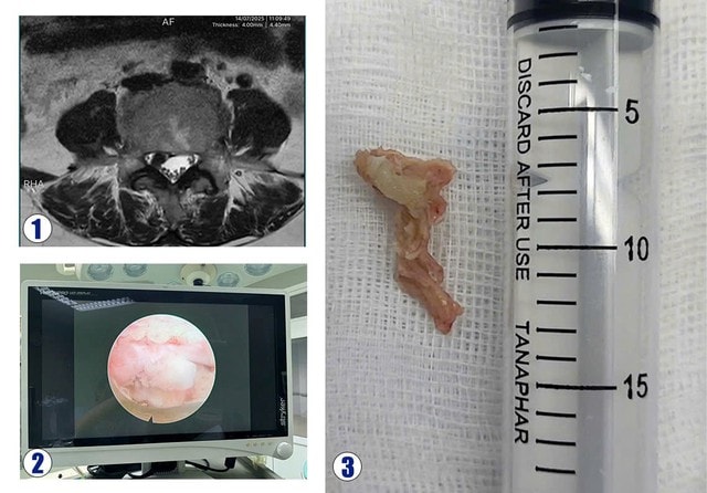Phẫu thuật nội soi cột sống: Giải pháp điều trị an toàn, thẩm mỹ- Ảnh 2. Phẫu thuật nội soi cột sống: Giải pháp điều trị an toàn, thẩm mỹ- Ảnh 2.