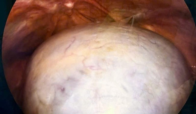 Phẫu thuật nội soi thành công khối u buồng trứng 'khổng lồ'- Ảnh 1.