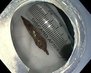 Ăn cháo yến, người phụ nữ bất ngờ bị hạt táo đỏ đâm thủng thành dạ dày- Ảnh 2. Ăn cháo yến, người phụ nữ bất ngờ bị hạt táo đỏ đâm thủng thành dạ dày- Ảnh 2.