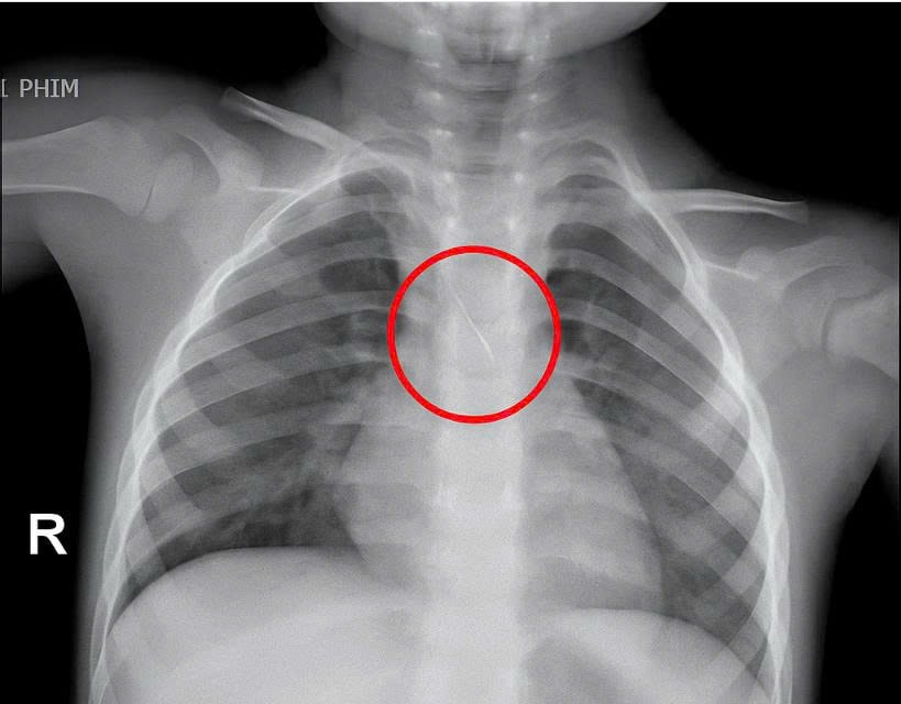 Kim chọc tủy bất ngờ rơi xuống đường thở bé 3 tuổi- Ảnh 1.