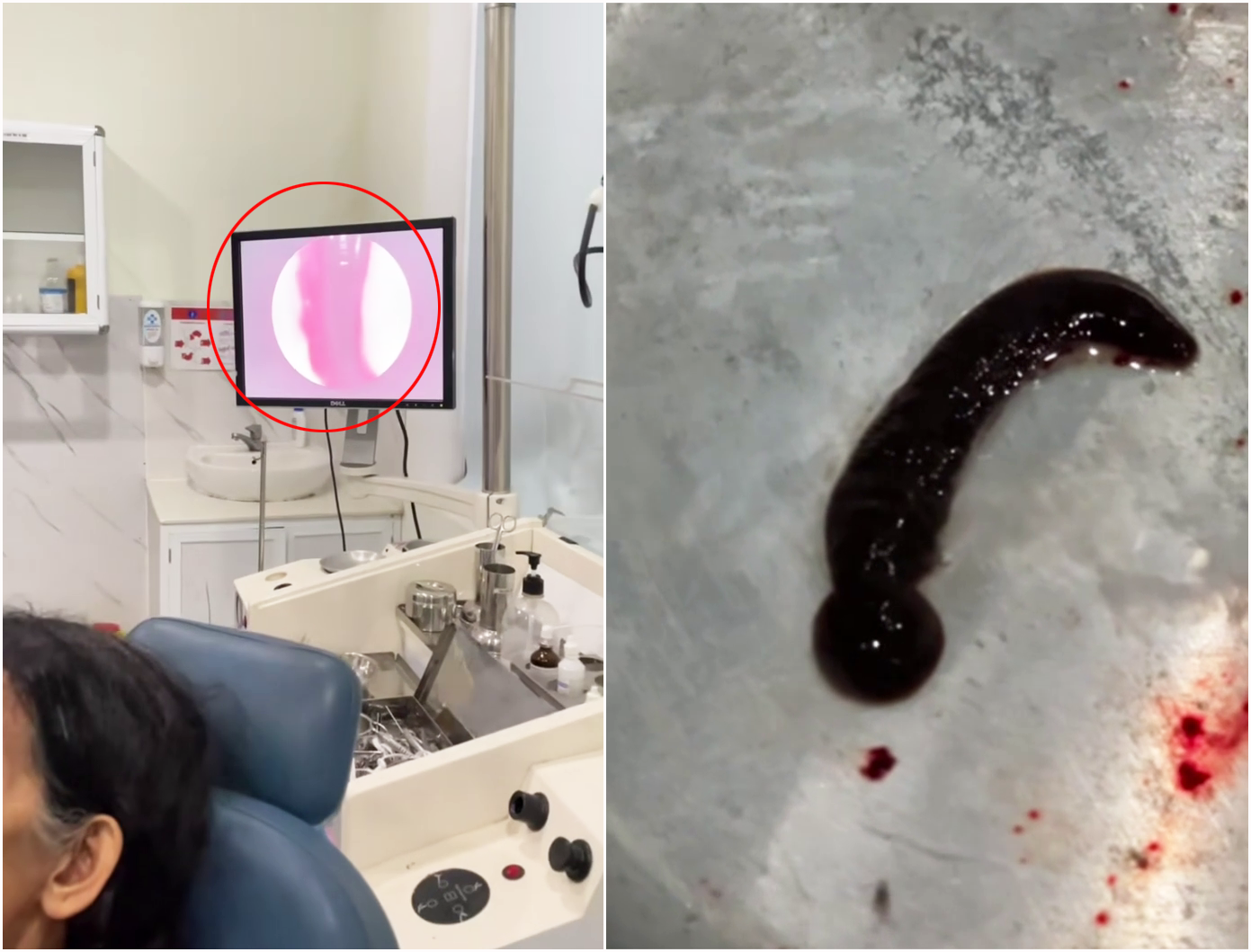 Hãi hùng con đỉa 6cm sống trong mũi cụ bà suốt 3 tuần- Ảnh 1.