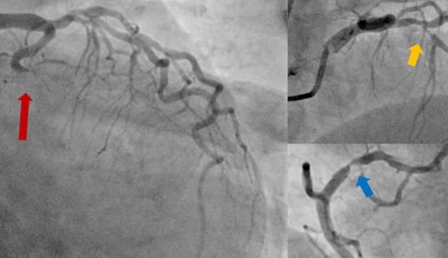 Cứu sống bệnh nhân hai lần ngưng tim- Ảnh 1.