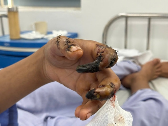 Máy cắt làm lóc da 3 ngón tay, hoại tử xương- Ảnh 2. Máy cắt làm lóc da 3 ngón tay, hoại tử xương- Ảnh 2.