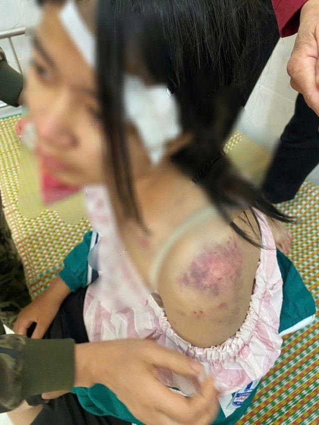 Những vết thương chi chít trên cơ thể của cô bé bị bạo hành- Ảnh 1.