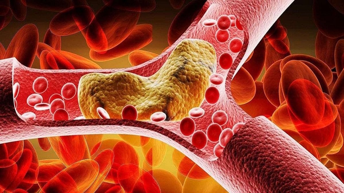 Người bệnh cần chú ý kiểm soát mỡ máu ở ngưỡng an toàn, ngăn chặn việc hình thành các mảng xơ vữa và tổn thương mạch máu. Ảnh minh họa