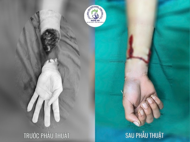 Nối thành công bàn tay đứt lìa qua mốc 'giờ vàng' – chạy đua cùng thời gian- Ảnh 1.