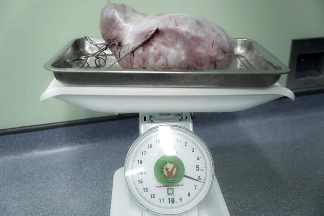 Phẫu thuật khối u nang buồng trứng nặng 6kg cho người phụ nữ 56 tuổi- Ảnh 3.