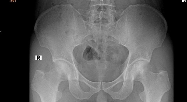 Thợ lặn biển hơn 20 năm bị hoại tử xương cánh tay, xương đùi- Ảnh 3.