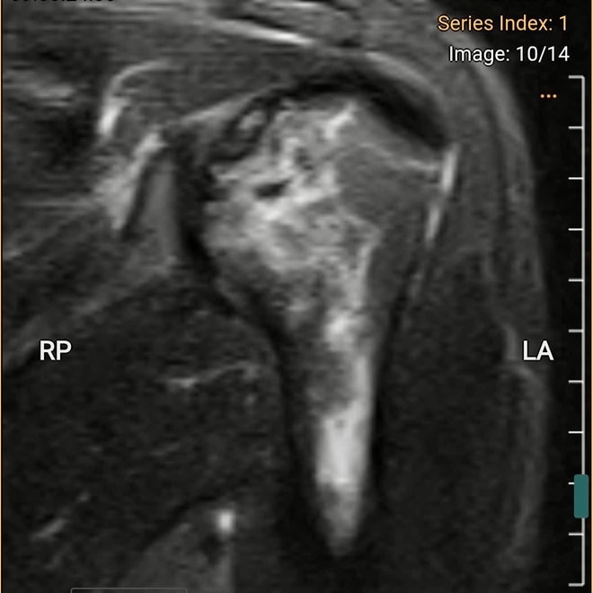 Thợ lặn biển hơn 20 năm bị hoại tử xương cánh tay, xương đùi- Ảnh 1.