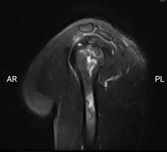 Thợ lặn biển hơn 20 năm bị hoại tử xương cánh tay, xương đùi- Ảnh 2.
