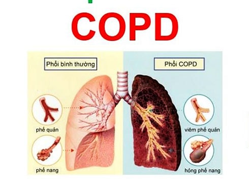 Chuyên gia khuyến nghị gì về COPD - căn bệnh là nguyên nhân tử vong thứ ba?- Ảnh 2.