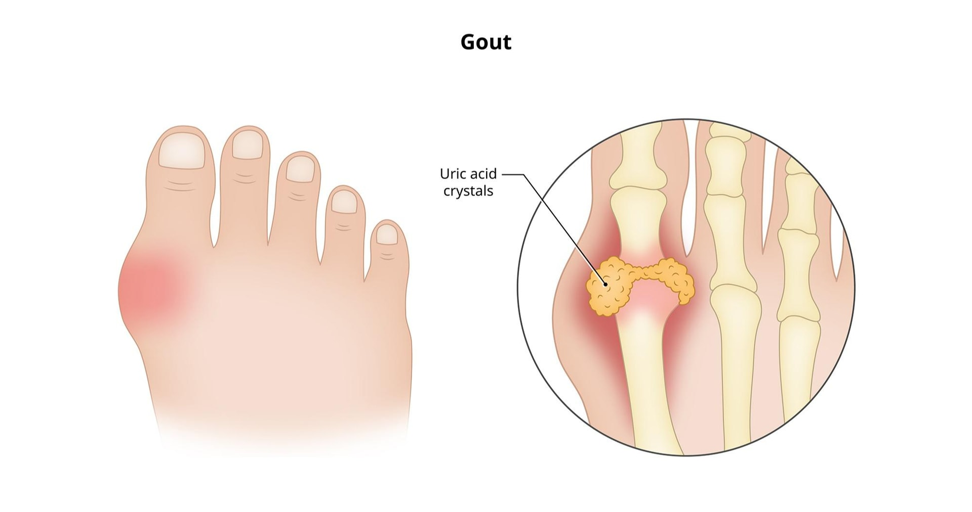Bệnh gout - Nguyên nhân, Triệu chứng & Dấu hiệu | Bệnh viện Gleneagles