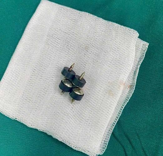 Bé trai nuốt 4 viên đinh nam châm đầu nhọn nguy hiểm- Ảnh 2.