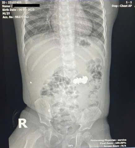 Bé trai nuốt 4 viên đinh nam châm đầu nhọn nguy hiểm- Ảnh 1.