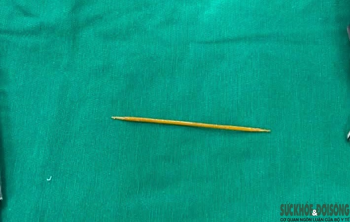 Người phụ nữ 66 tuổi thủng đại tràng vì ngậm tăm khi ngủ- Ảnh 2.