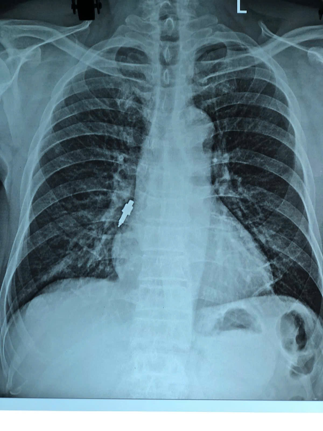 Ho kéo dài sau khi làm răng, người đàn ông phát hiện dụng cụ nha khoa trong phế quản- Ảnh 2.