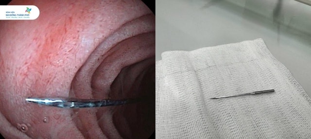 Bé trai 11 tuổi suýt mất mạng vì nuốt kim may đồ dài 4cm- Ảnh 1. Bé trai 11 tuổi suýt mất mạng vì nuốt kim may đồ dài 4cm- Ảnh 1.