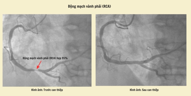 Kích hoạt 'báo động đỏ' lúc rạng sáng cứu sống du khách nước ngoài nhồi máu cơ tim cấp- Ảnh 1.