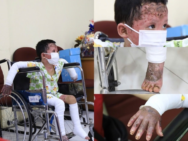 Bệnh nhi bỏng 65% vụ phóng hỏa ở Gia Lai hồi phục ngoạn mục sau 38 ngày điều trị- Ảnh 2.