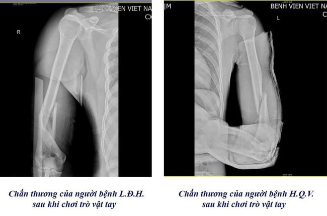 Cảnh báo nguy cơ gẫy xương cánh tay từ trò vật tay- Ảnh 1.