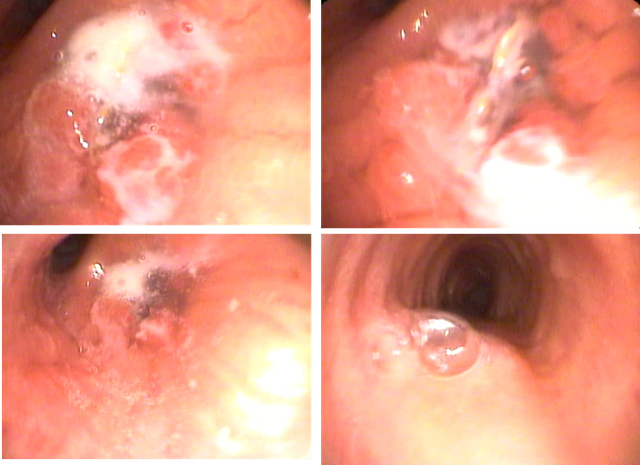 Ho khan nhiều tháng, cụ ông bất ngờ được phát hiện dị vật mắc sâu trong đường thở- Ảnh 1.