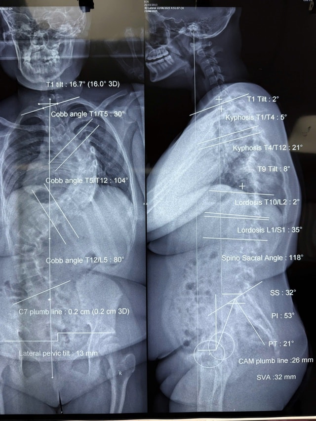 Hành trình nắn lại 'xương sống khủng long' cho hai bé gái- Ảnh 2. Hành trình nắn lại 'xương sống khủng long' cho hai bé gái- Ảnh 2.
