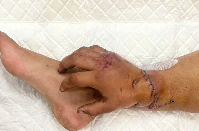 Bác sĩ Võ Thái Trung, BVĐK Bình Dương kể về ca ghép tạm bàn tay vào chân hiếm gặp, cứu mẹ và hai thai nhi- Ảnh 2. Bác sĩ Võ Thái Trung, BVĐK Bình Dương kể về ca ghép tạm bàn tay vào chân hiếm gặp, cứu mẹ và hai thai nhi- Ảnh 2.