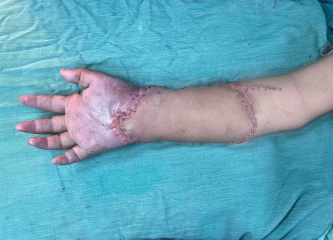 Bác sĩ Võ Thái Trung, BVĐK Bình Dương kể về ca ghép tạm bàn tay vào chân hiếm gặp, cứu mẹ và hai thai nhi- Ảnh 3. Bác sĩ Võ Thái Trung, BVĐK Bình Dương kể về ca ghép tạm bàn tay vào chân hiếm gặp, cứu mẹ và hai thai nhi- Ảnh 3.