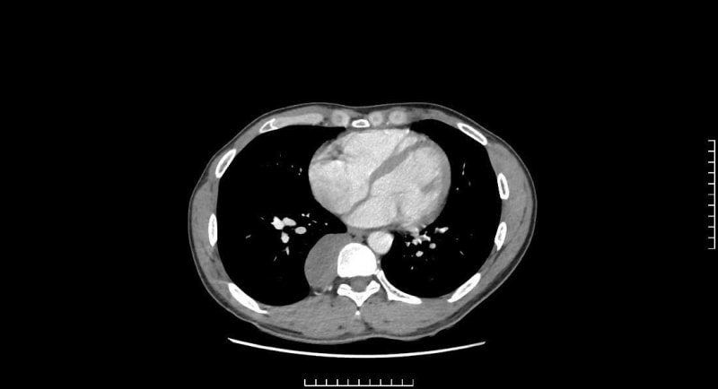 Nam thanh niên có khối u trung thất sau, biến chứng nguy hiểm - Ảnh 1. Nam thanh niên có khối u trung thất sau, biến chứng nguy hiểm - Ảnh 1.
