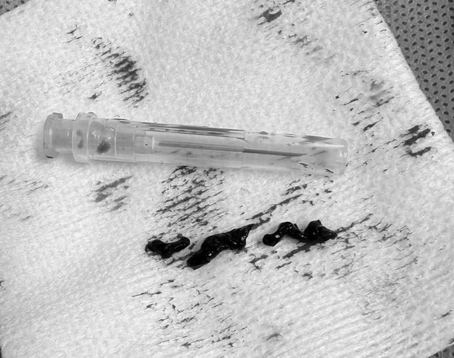 Cụ bà nhiều bệnh nền thoát chết sau cơn đột quỵ trong nhà vệ sinh- Ảnh 1. Cụ bà nhiều bệnh nền thoát chết sau cơn đột quỵ trong nhà vệ sinh- Ảnh 1.