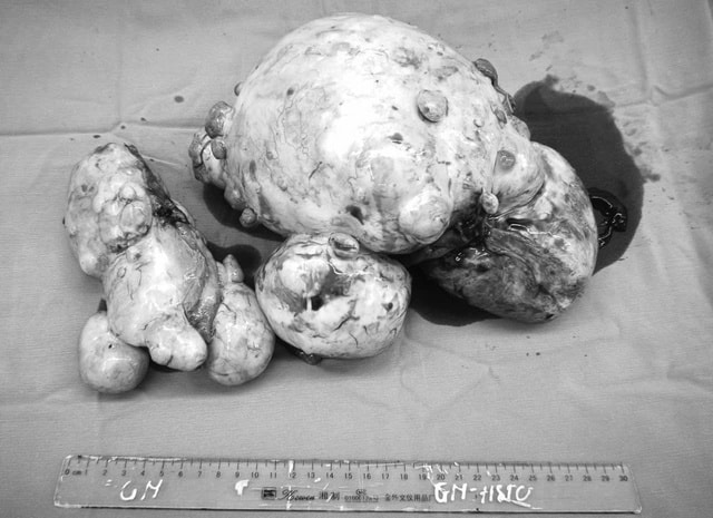 Bất ngờ phát hiện u buồng trứng sau chấn thương sọ não- Ảnh 2. Bất ngờ phát hiện u buồng trứng sau chấn thương sọ não- Ảnh 2.