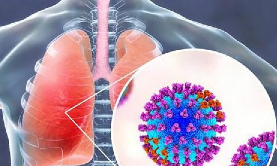 Bệnh do virus hợp bào hô hấp (RSV) có cần dùng thuốc?- Ảnh 1. Bệnh do virus hợp bào hô hấp (RSV) có cần dùng thuốc?- Ảnh 1.