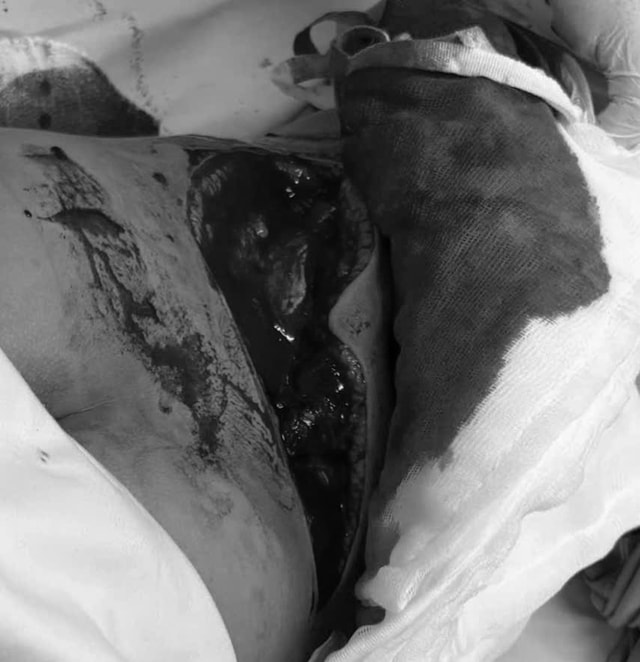 Bồn cầu bất ngờ vỡ khi đứng lên, bé trai 8 tuổi bị rách 25 cm lưng- Ảnh 1. Bồn cầu bất ngờ vỡ khi đứng lên, bé trai 8 tuổi bị rách 25 cm lưng- Ảnh 1.