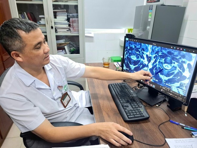 Thiếu nữ 23 tuổi bị liệt dần vì bóng cười, hít 12–15 giờ liền gia đình không hề biết- Ảnh 2. Thiếu nữ 23 tuổi bị liệt dần vì bóng cười, hít 12–15 giờ liền gia đình không hề biết- Ảnh 2.