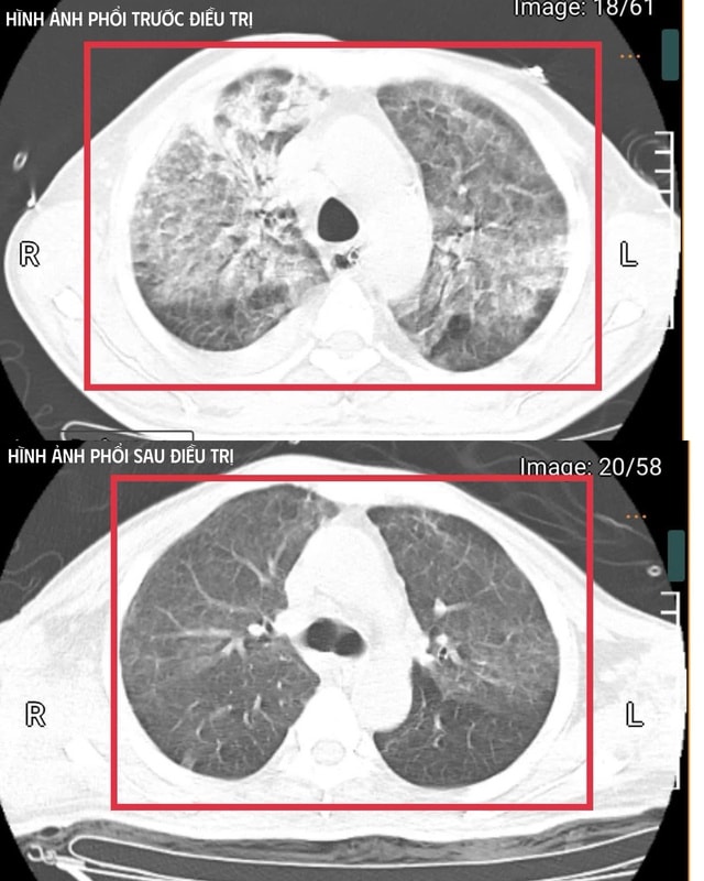 Người đàn ông về từ Thái Lan mắc Whitmore thể cực nguy hiểm- Ảnh 1.