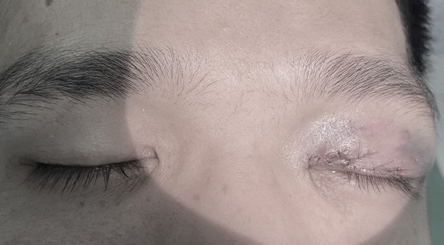 Mắt dập nát do tai nạn lao động, bệnh nhân được cứu thoát nguy cơ mất thị lực- Ảnh 1. Mắt dập nát do tai nạn lao động, bệnh nhân được cứu thoát nguy cơ mất thị lực- Ảnh 1.